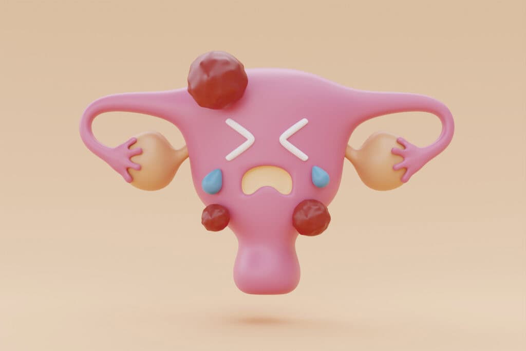 PCOS