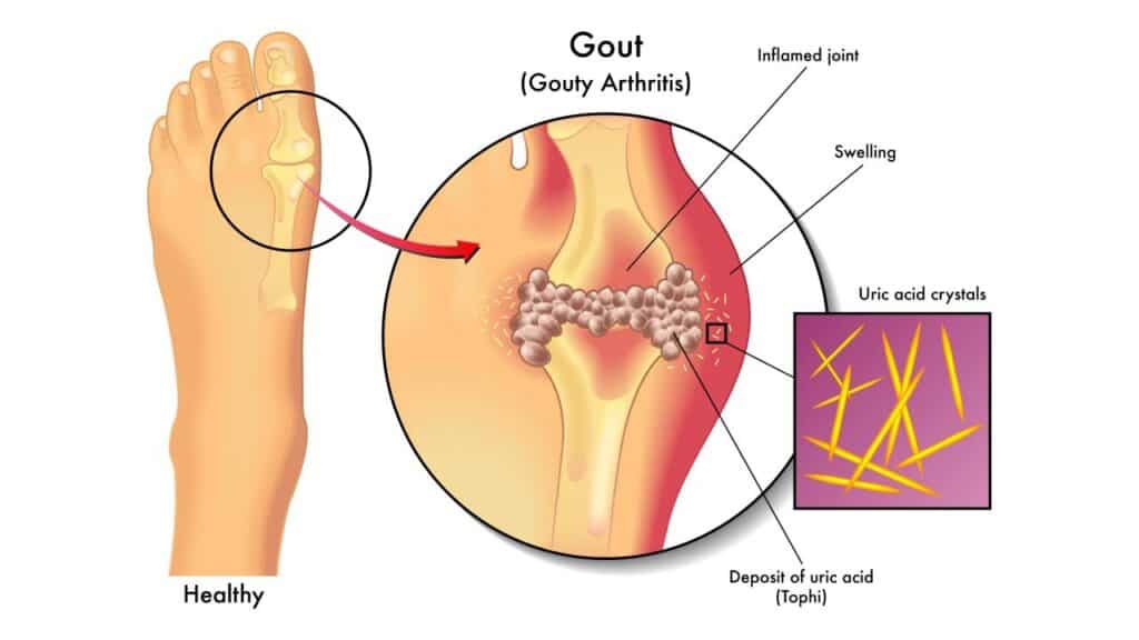 Penumpukan kristal asam urat pada sendi