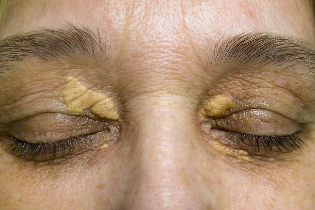 Xanthelasma Kolesterol Tinggi