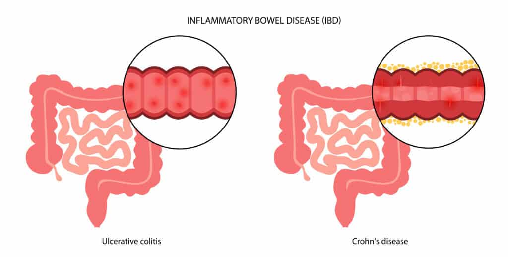 Ilustrasi Inflammatory bowel disease