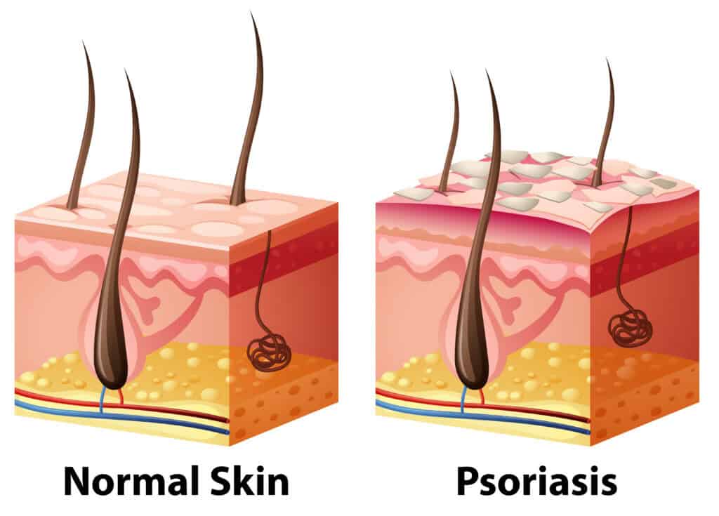 Ilustrasi kulit normal dan psoriasis