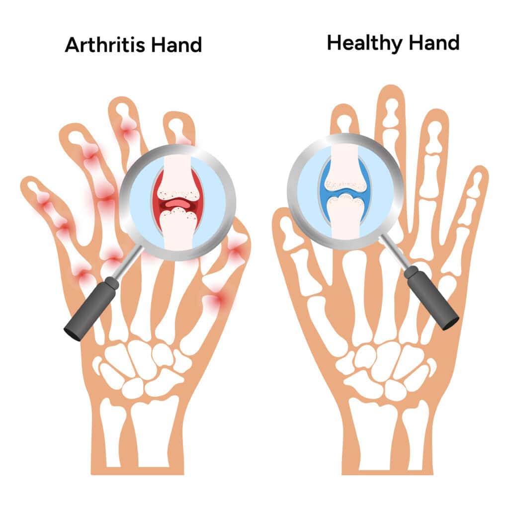 Ilustrasi sendi normal dan rheumatoid arthritis