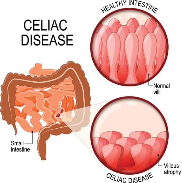 Ilustrasi usus sehat dan usus dengan celiac disease
